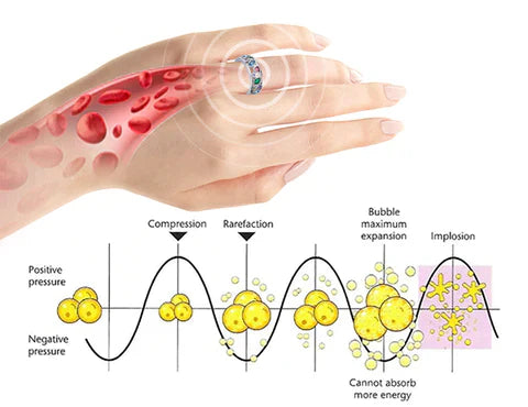 Ultraschall-Kavitationstherapie zur Fettentfernung, grafische Darstellung, Hand mit Ring.