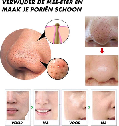 Nahaufnahme einer Nase mit Mitessern, Vorher-Nachher-Bilder, Porenreinigung, Hautpflege.