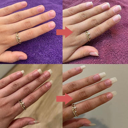 Före och efter-bilder av två händer med ring som visar naglarna innan och efter behandlingen 9