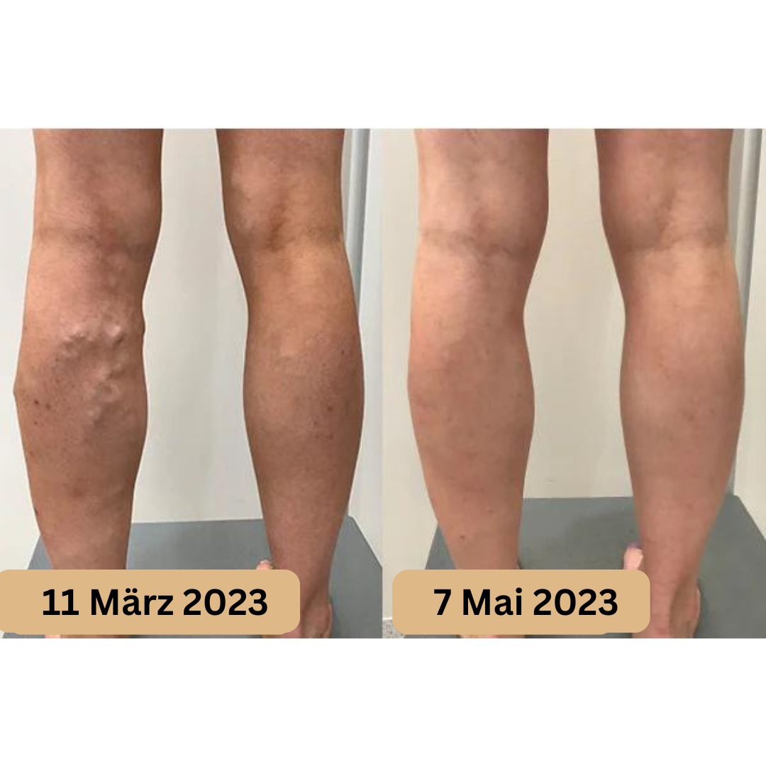 Vorher-Nachher-Bild von Beinen mit Krampfadern, Verbesserung nach Akupressur, März bis Mai 2023.