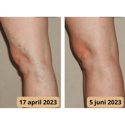 Vorher-Nachher-Bild von Beinen mit Krampfadern, Behandlungserfolg, April bis Juni 2023.