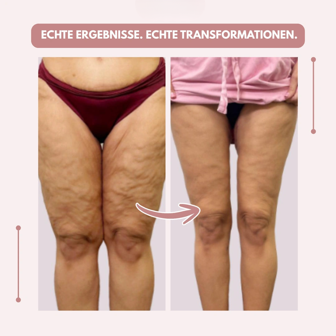 Före- och efterbild av lår och knän framifrån, med bildtext om verkliga resultat och transformationer. 12