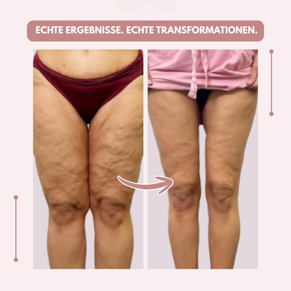 Före- och efterbild av lår och knän framifrån, med bildtext om verkliga resultat och transformationer. 12