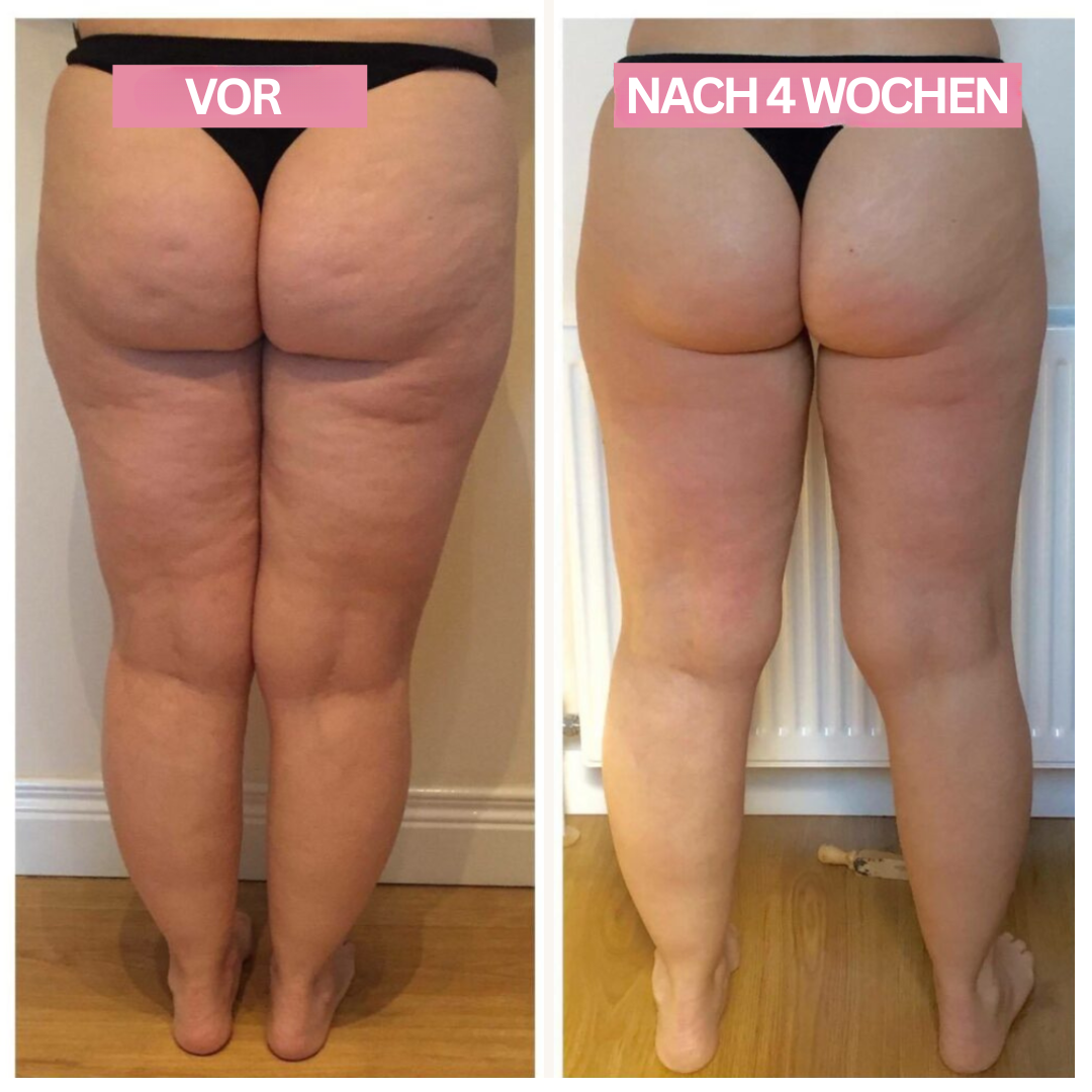 Vorher-Nachher-Bild Cellulite-Behandlung, Rückansicht Beine, 4 Wochen Unterschied, Hautstraffung.