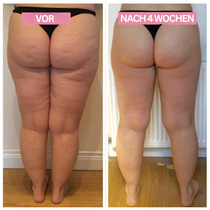 Vorher-Nachher-Bild Cellulite-Behandlung, Rückansicht Beine, 4 Wochen Unterschied, Hautstraffung.