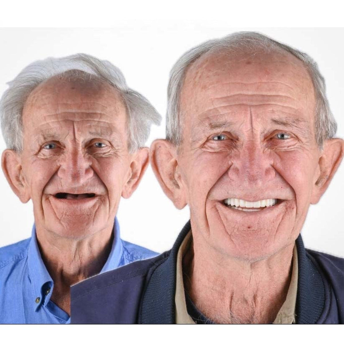 Före- och efterbild av en äldre man, först med tandlös mun och sedan med ett brett leende med vita tänder. 6